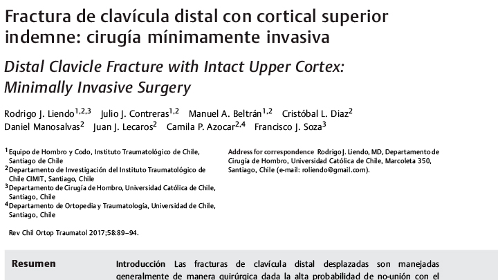 Fracturadeclavículadistalconcorticalsuperiorindemne:cirugíamínimamenteinvasiva – Dr. Julio Contreras